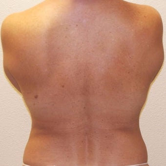 50 yr old woman treated with SmartLipo MPX before 2423006