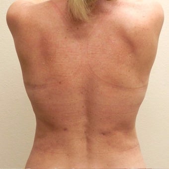 50 yr old woman treated with SmartLipo MPX after 2423006