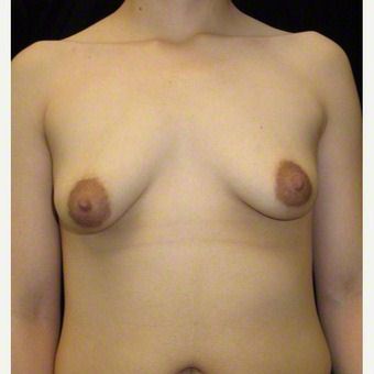 24 year old woman treated with Breast Augmentation for Asymmetry after 3103592