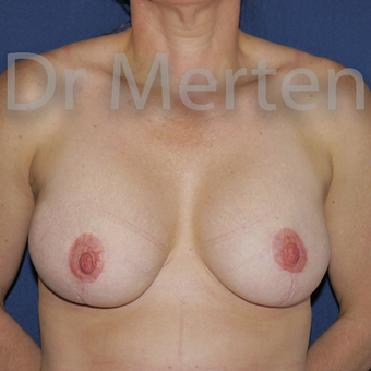 35-44 year old woman treated with Breast Lift with Implants after 3595322
