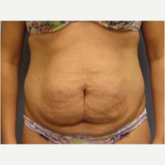 25-34 year old woman treated with Tummy Tuck before 3726336
