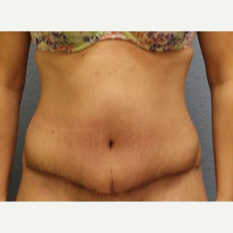 25-34 year old woman treated with Tummy Tuck after 3726336
