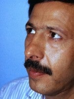45-54 year old man treated with Rhinoplasty before 3104008
