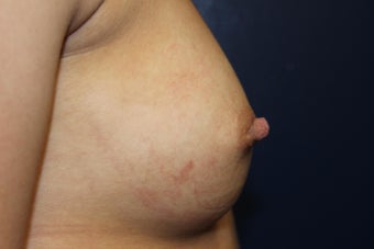 20 year old female with inverted right nipple 1051402