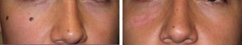 Mole Removal photos before 951872