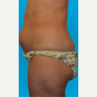 45-54 year old woman treated with Liposuction before 3275388