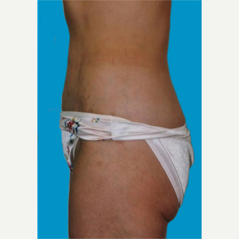 45-54 year old woman treated with Liposuction after 3275388