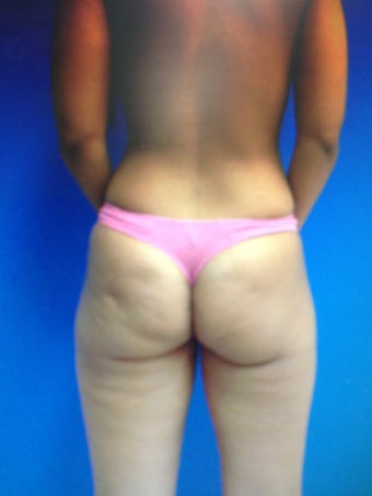 22 year old female following breast augmentation and gluteal augmentation with both implants and fat grafting before 1203988