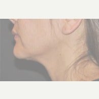 correction of witch’s chin deformitty after 2617342