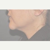 correction of witch’s chin deformitty before 2617342