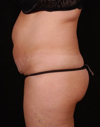 Abdominoplasty before 96413