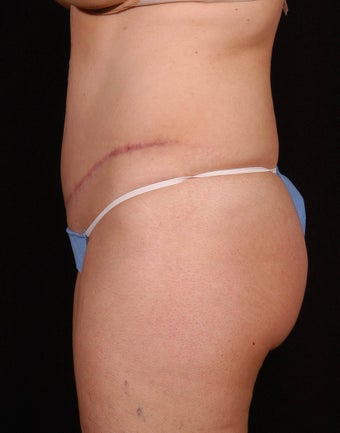 Abdominoplasty after 96413