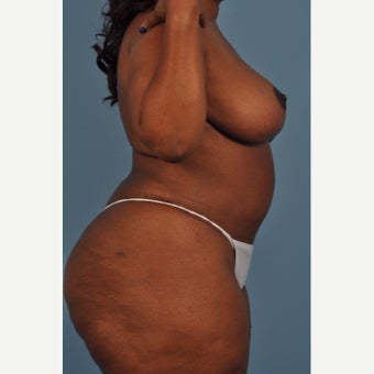 45-54 year old woman treated with Mommy Makeover after 2195333