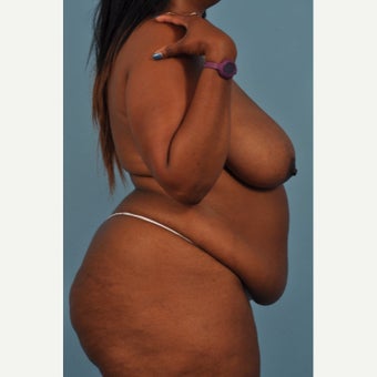45-54 year old woman treated with Mommy Makeover before 2195333