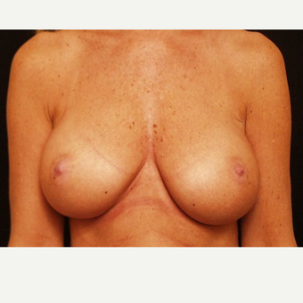 55-64 year old woman treated with Breast Augmentation after 3523759