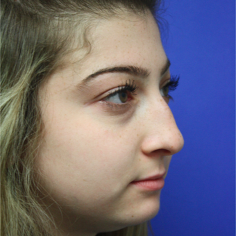 18-24 year old woman treated with Rhinoplasty before 3400334