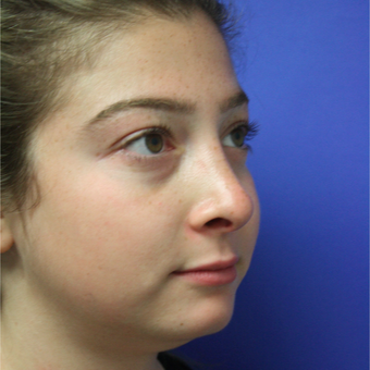 18-24 year old woman treated with Rhinoplasty after 3400334