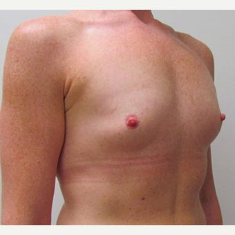 25-34 year old woman treated with Breast Implants before 3030481
