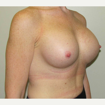 25-34 year old woman treated with Breast Implants after 3030481