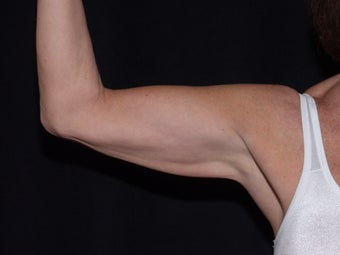Smart Lipo Arms after 624882