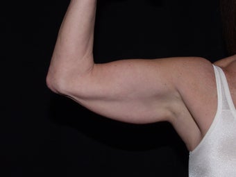 Smart Lipo Arms before 624882