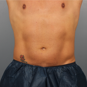 39 year old man treated with CoolSculpting to the abdomen and flanks after 3507332