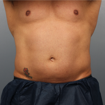 39 year old man treated with CoolSculpting to the abdomen and flanks before 3507332