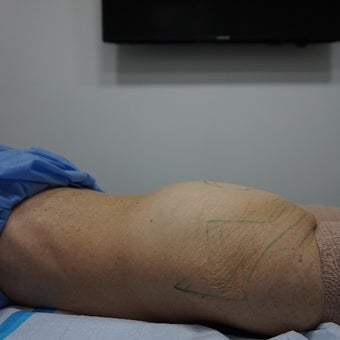 55-64 year old woman treated with Liposuction Revision before 2610117