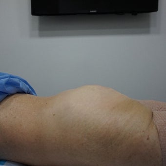 55-64 year old woman treated with Liposuction Revision after 2610117