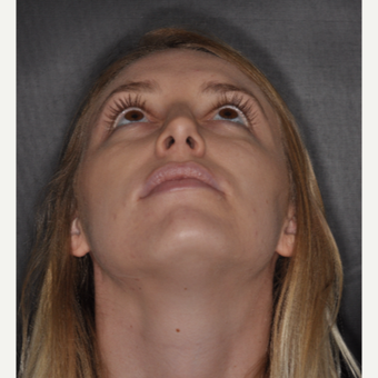 18-24 year old woman treated with Rhinoplasty 1 year post-op after 3499778