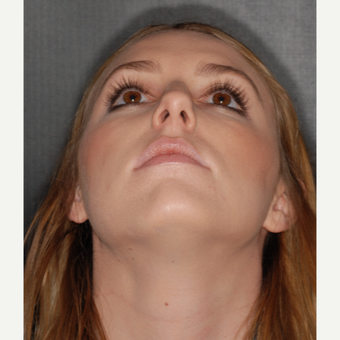 18-24 year old woman treated with Rhinoplasty 1 year post-op before 3499778