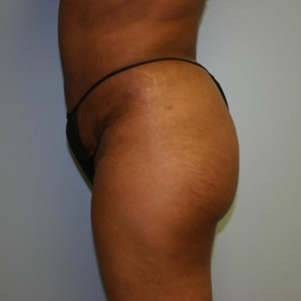 Brazilian Butt Lift after 3667526