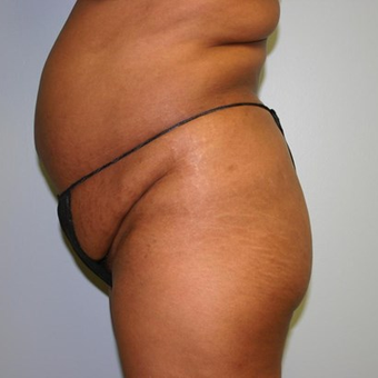 Brazilian Butt Lift before 3667526