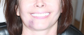 All-on-4 Dental Implants after 1138387