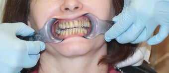 All-on-4 Dental Implants before 1138387
