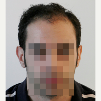 25-34 year old man treated with FUE Hair Transplant before 3068866