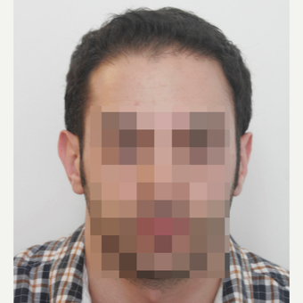 25-34 year old man treated with FUE Hair Transplant after 3068866
