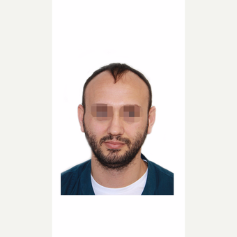 35-44 year old man treated with Organic Hair Transplant before 3280175