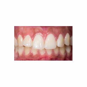 Short teeth treated treated with Gum Lift after 3696376