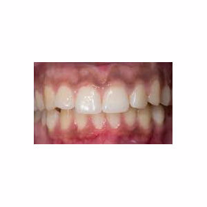 Short teeth treated treated with Gum Lift before 3696376