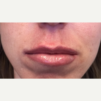 25-34 year old woman treated with Lip Augmentation after 3425093