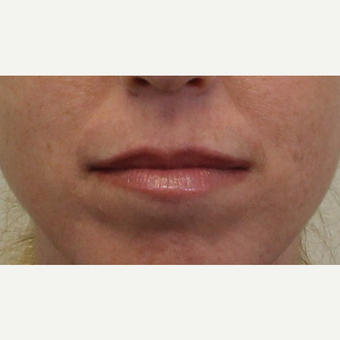 25-34 year old woman treated with Lip Augmentation before 3425093