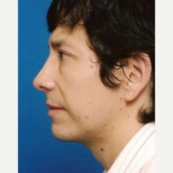 35-44 year old man treated with Chin Implant after 1637248