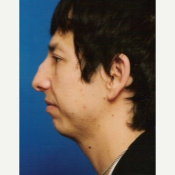 35-44 year old man treated with Chin Implant before 1637248