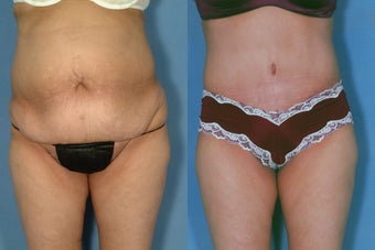 Tummy Tuck after 251551