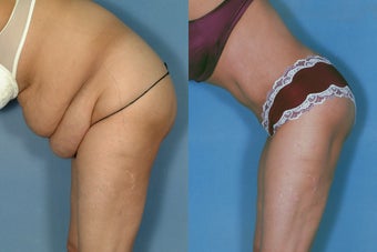 Tummy Tuck before 251551