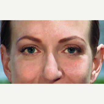 25-34 year old woman treated with Ptosis and Blepharoplasty Surgery after 3456315