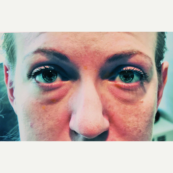 25-34 year old woman treated with Ptosis and Blepharoplasty Surgery before 3456315