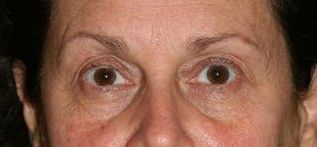 Restylane L to Tear trough before 1110407