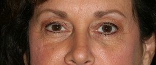 Restylane L to Tear trough after 1110407